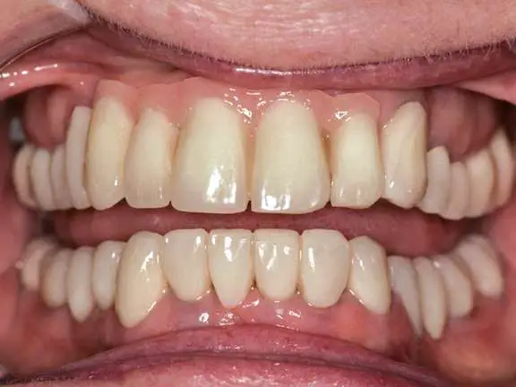 Complete &  Partial Dentures