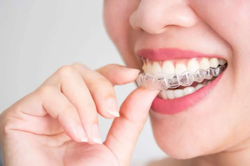 Dentist Yeronga Guide: Does Invisalign Work?