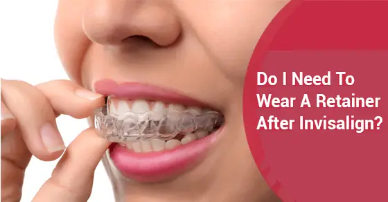 Do I Need To Wear A Retainer After Invisalign?