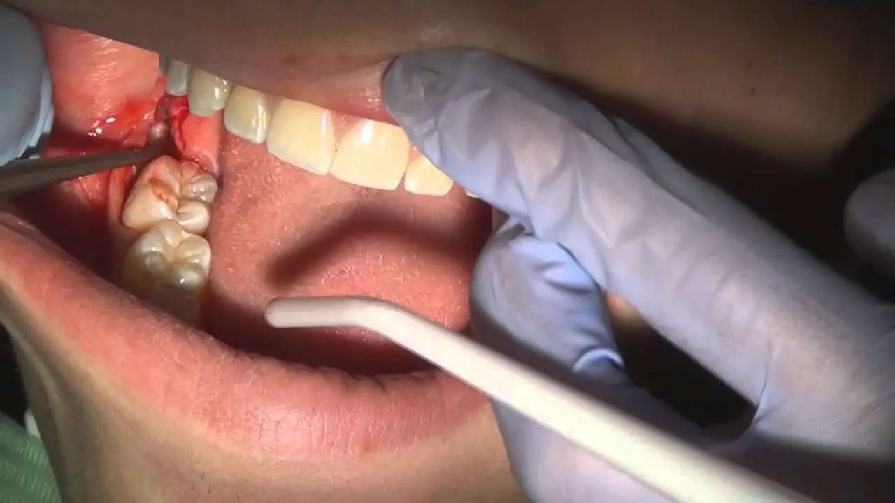 How to pull a wisdom tooth (fully impacted).
