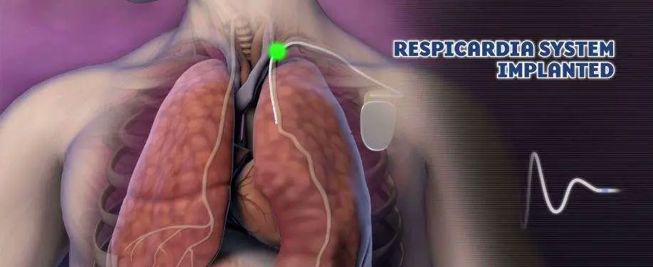Implanted Device Successfully Treats Central Sleep Apnea, Study Finds ...