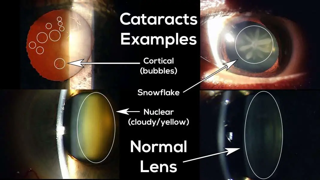 Life AFTER Cataract Surgery: Here