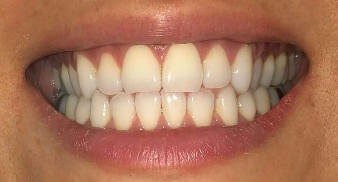 My Invisalign Review: Before and After Crossbite ...