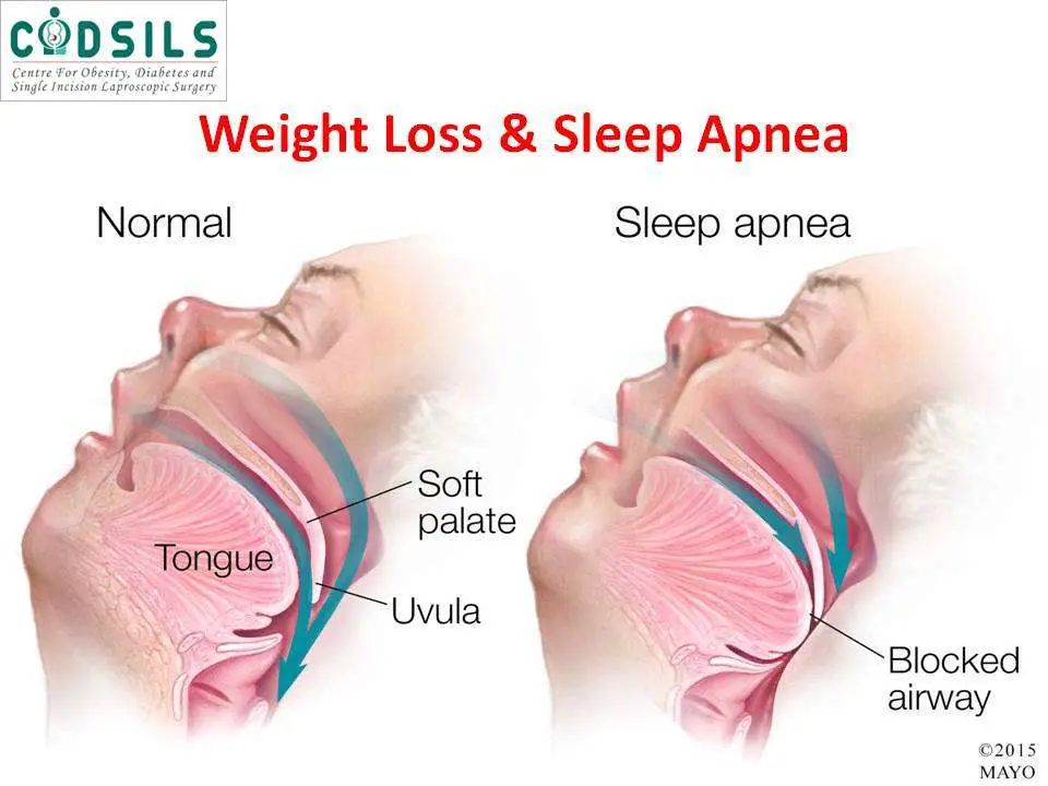 Sleep Apnea And Weight Loss