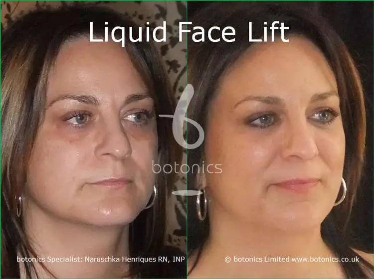 Tear Trough Fillers Before and After Photos Comparison in London, UK