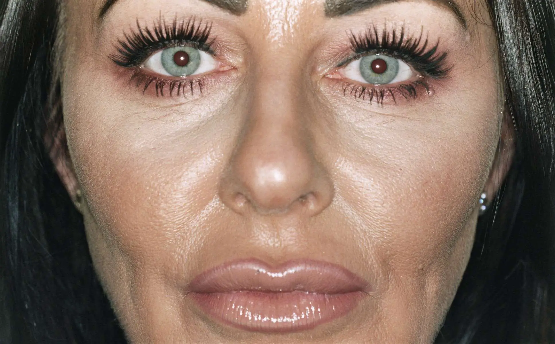 This is what 10 years of Botox looks like