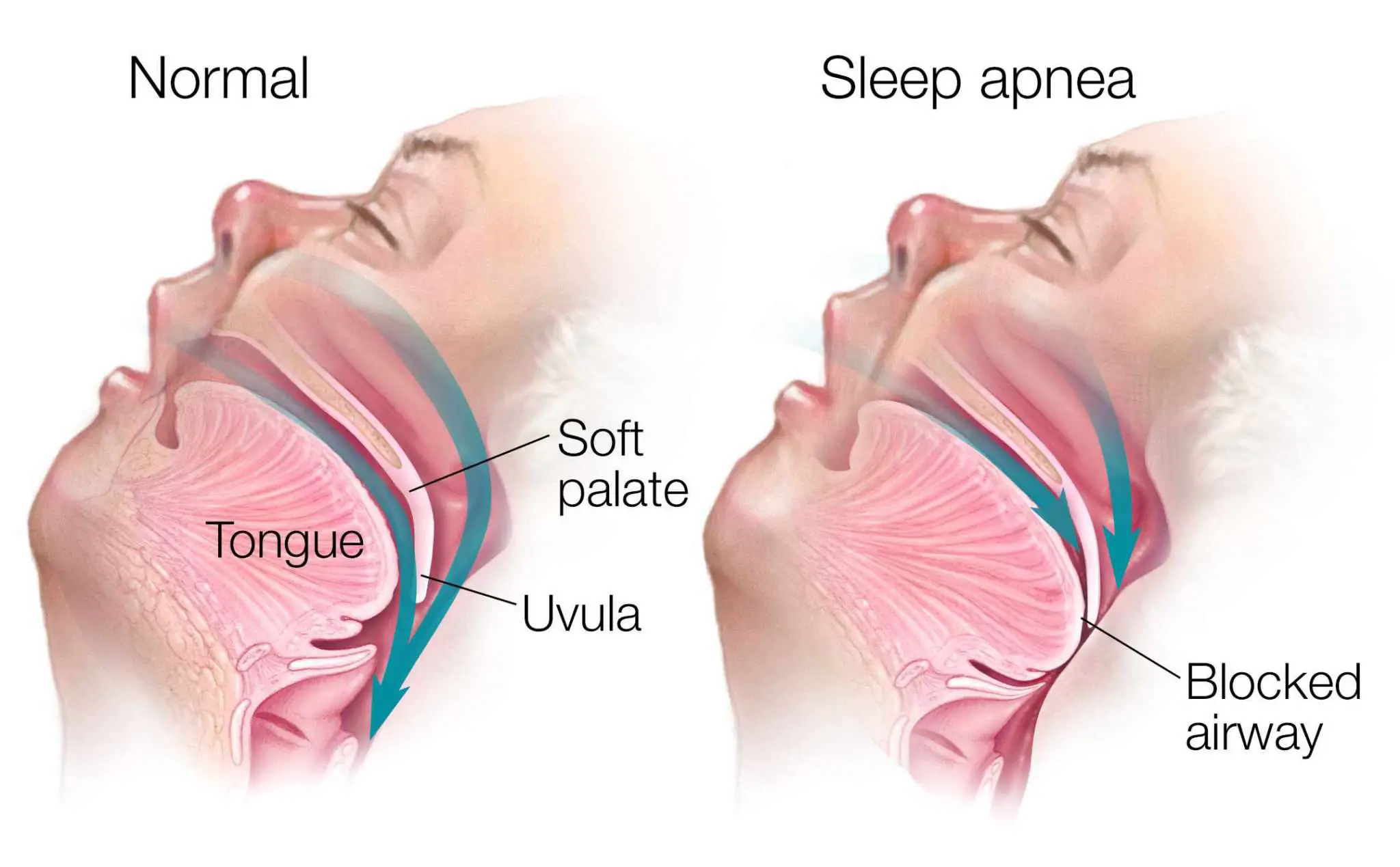 WHAT ARE THE SIGNS AND SYMPTOMS OF SLEEP APNEA?