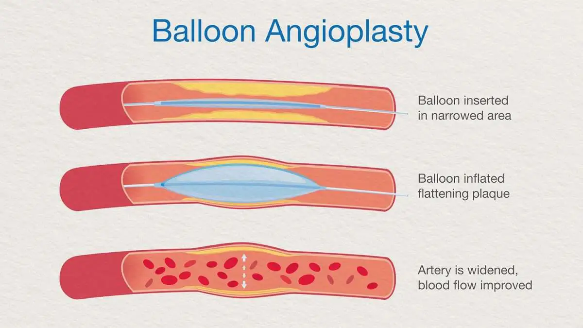 What Is Angioplasty?