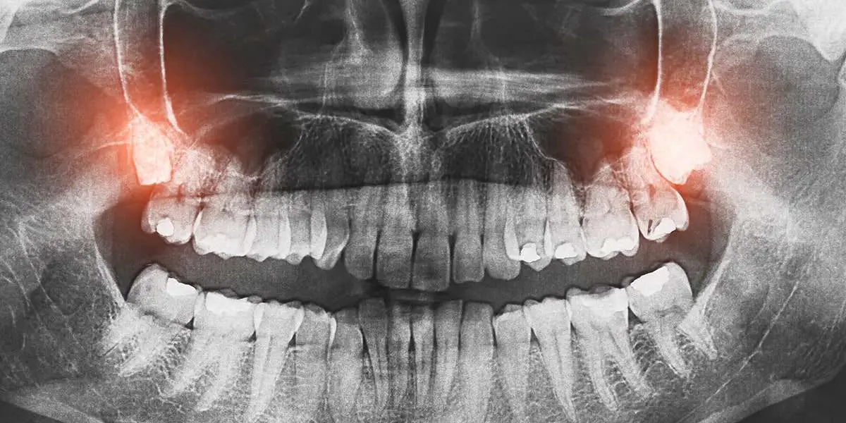 Wisdom Teeth Removal: What to Expect Before, During, and After